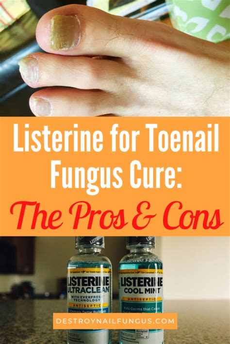 Have any of you successfully treated/cured toenail fungus.